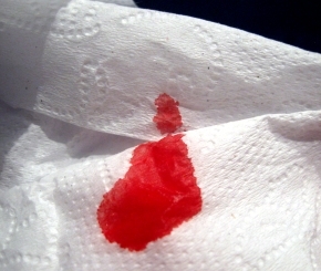 гемороїдальна кровотеча