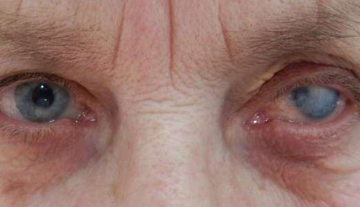 Причини і лікування більма на оці