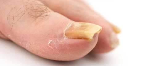 Псоріаз нігтів фото симптоми