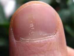 Псоріаз нігтів лікування