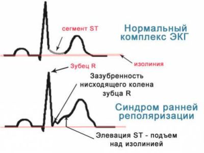Синдром ранньої реполяризації шлуночків серця